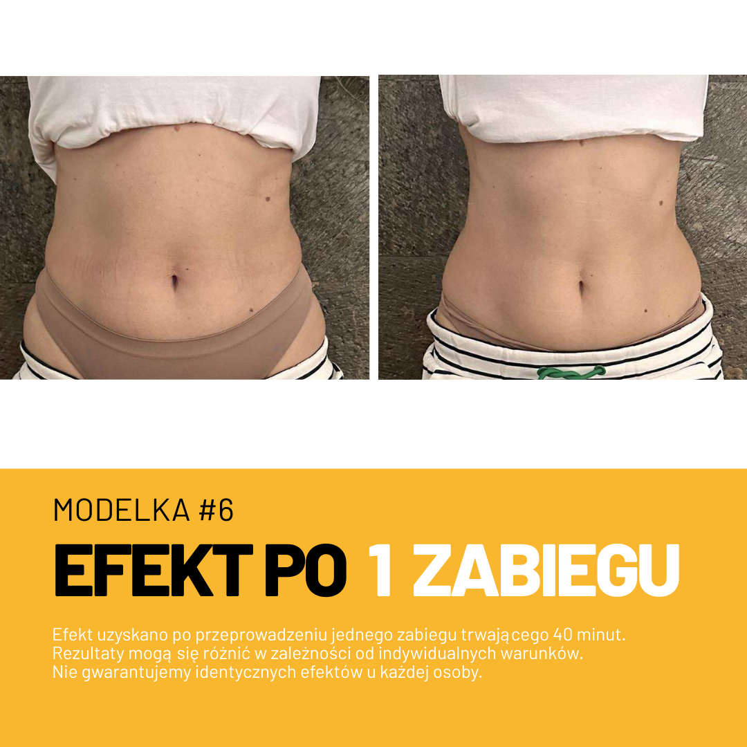 Efekt zabiegu Adipologie 2