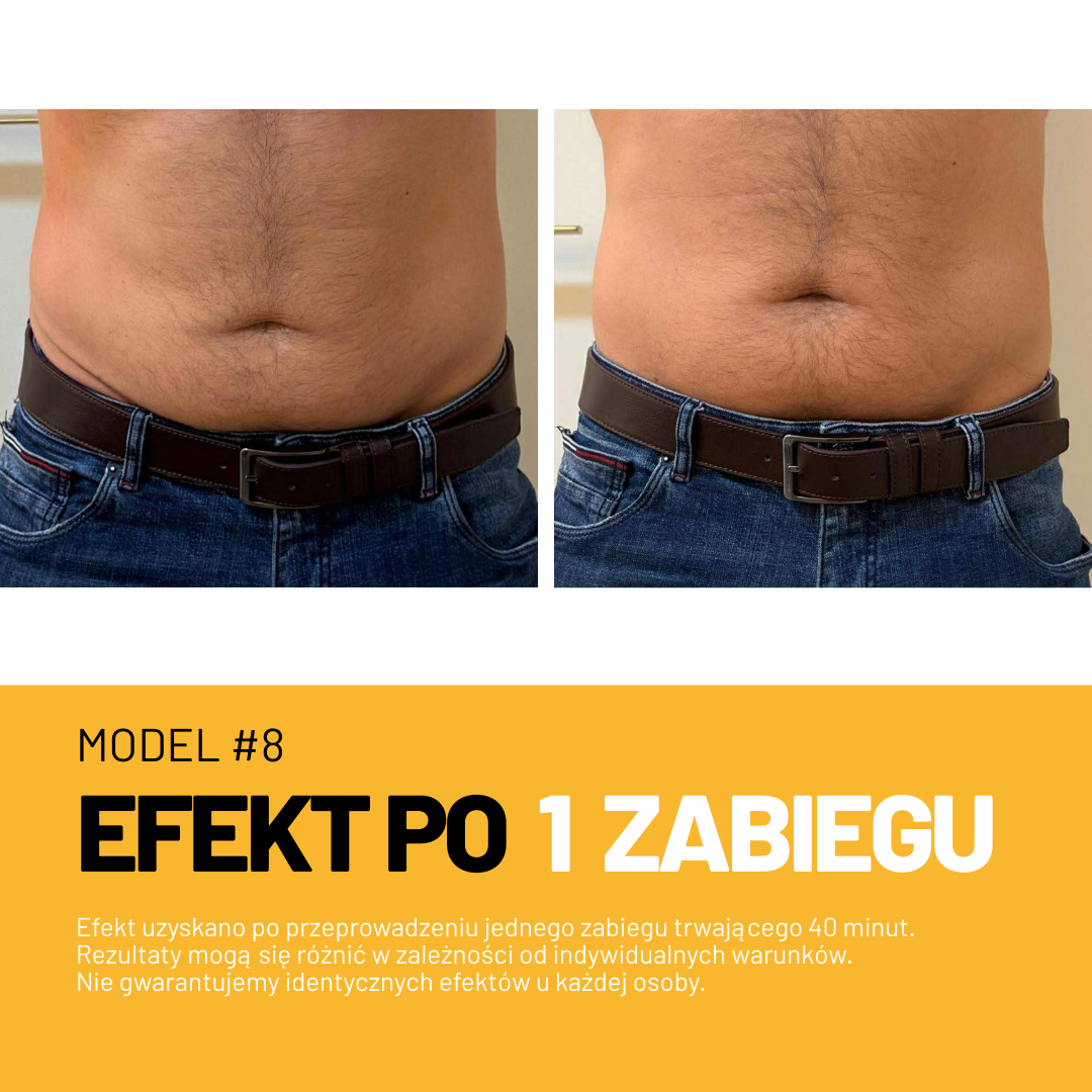 Efekt zabiegu Adipologie 1