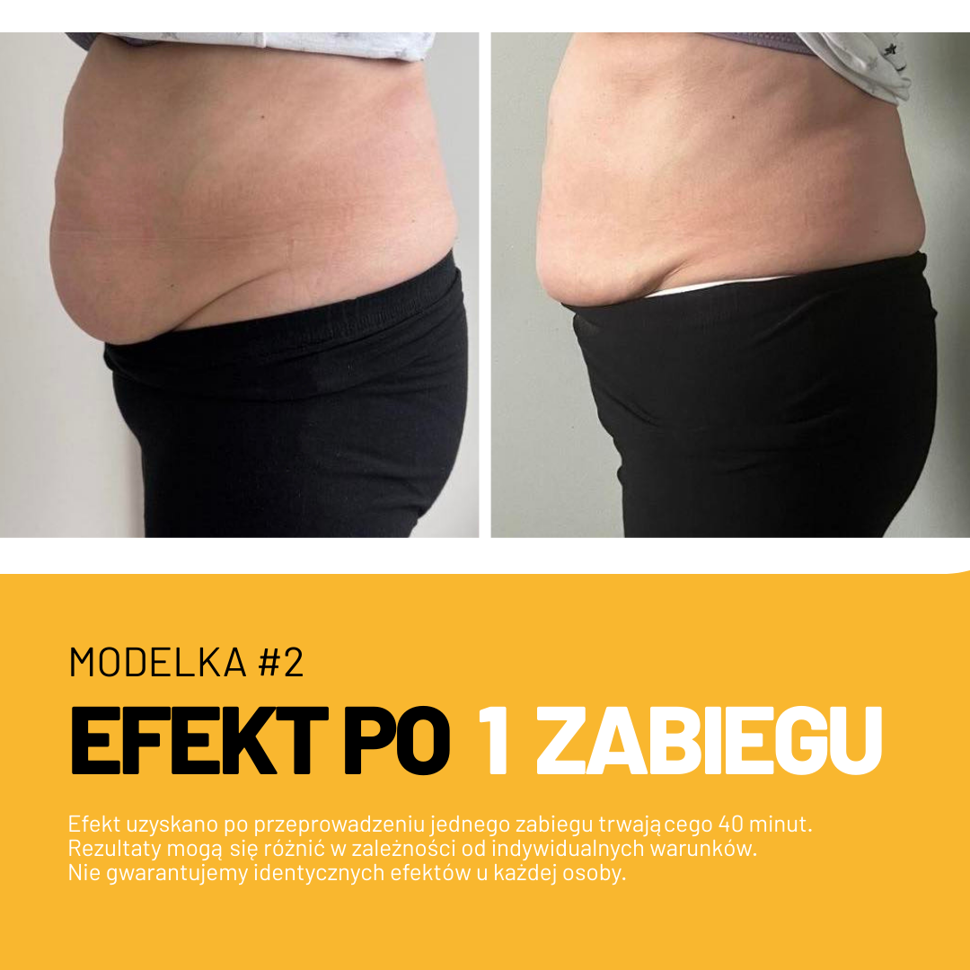 Efekt zabiegu Adipologie 3