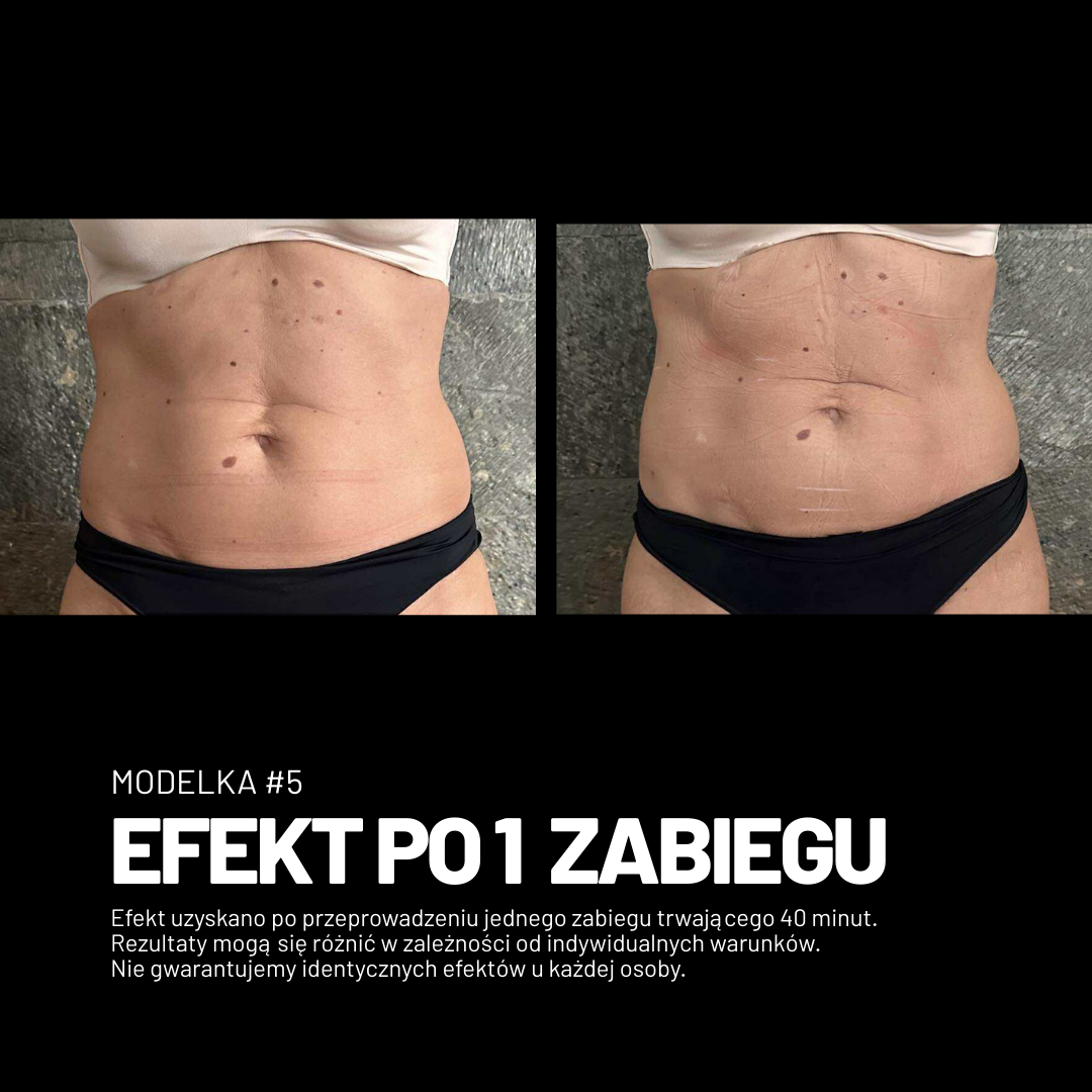 Efekt zabiegu Adipologie 1