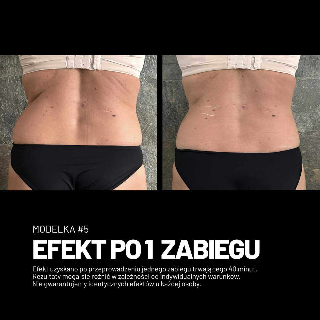 Efekt zabiegu Adipologie 2
