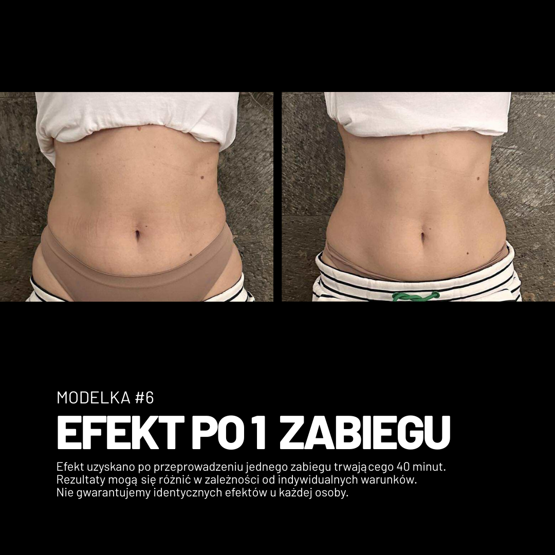 Efekt zabiegu Adipologie 3