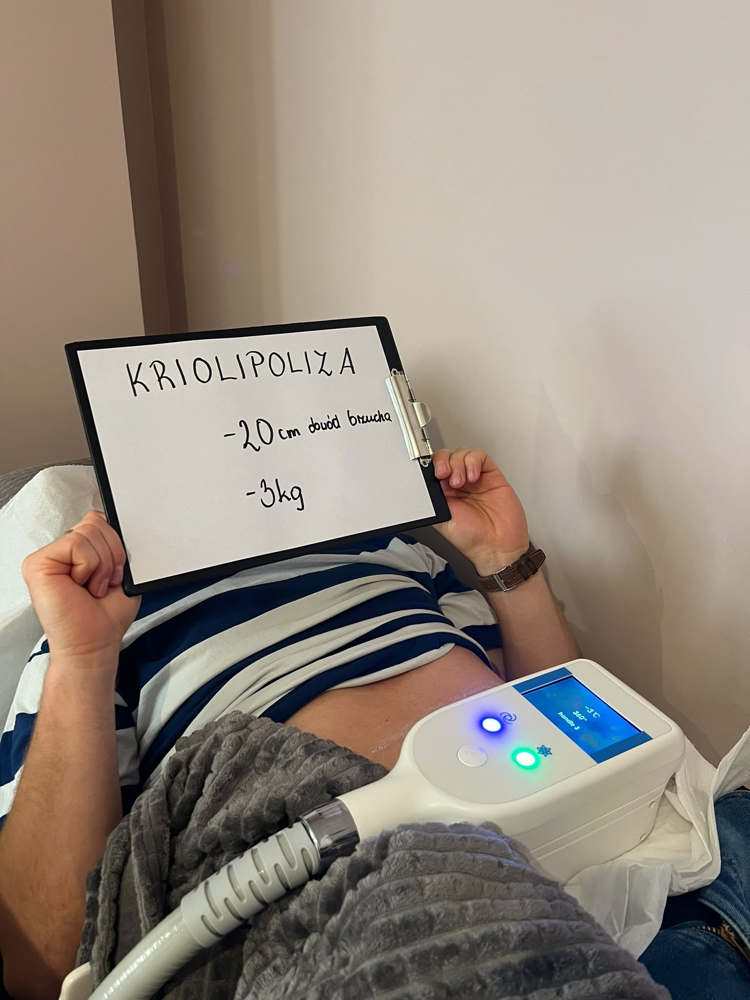 Efekt zabiegu kriolipolizy 1