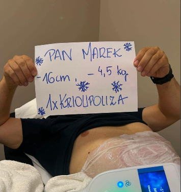 Efekt zabiegu kriolipolizy 3